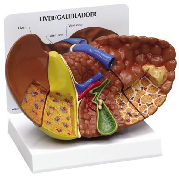 Gpi Anatomical Anatomical Model - Liver Cancer 3310